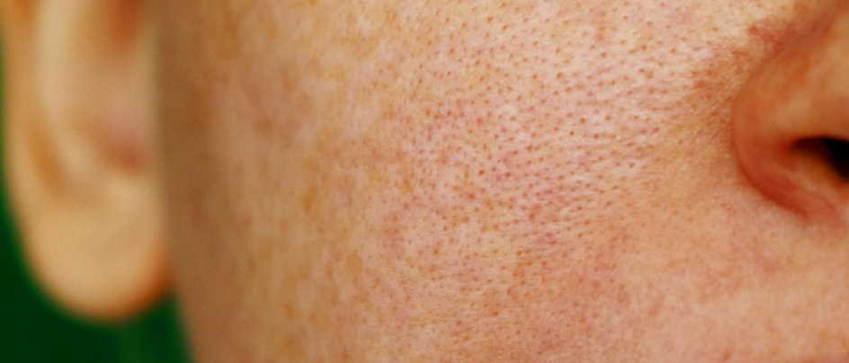 surface of the skin